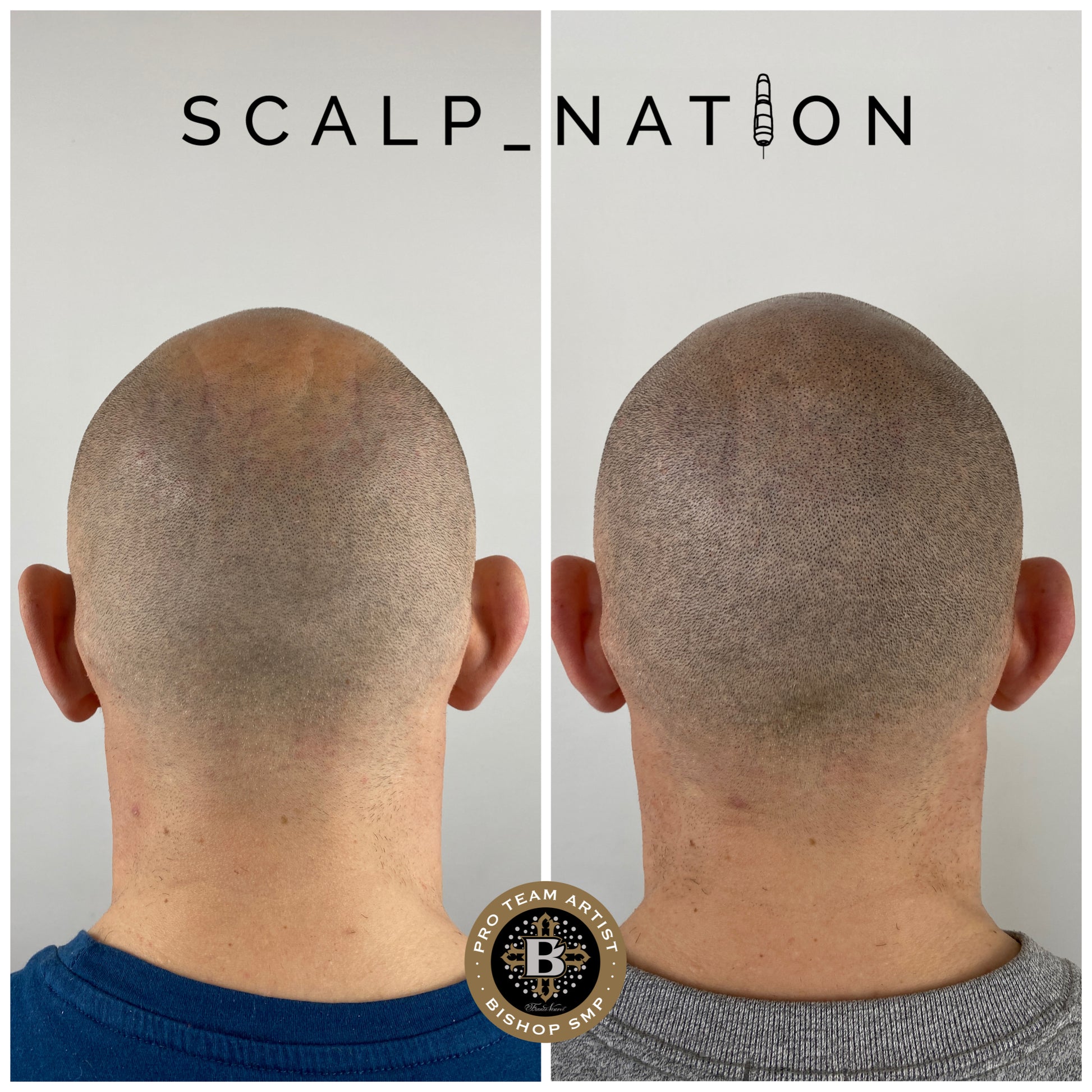 scalp micropigmentation