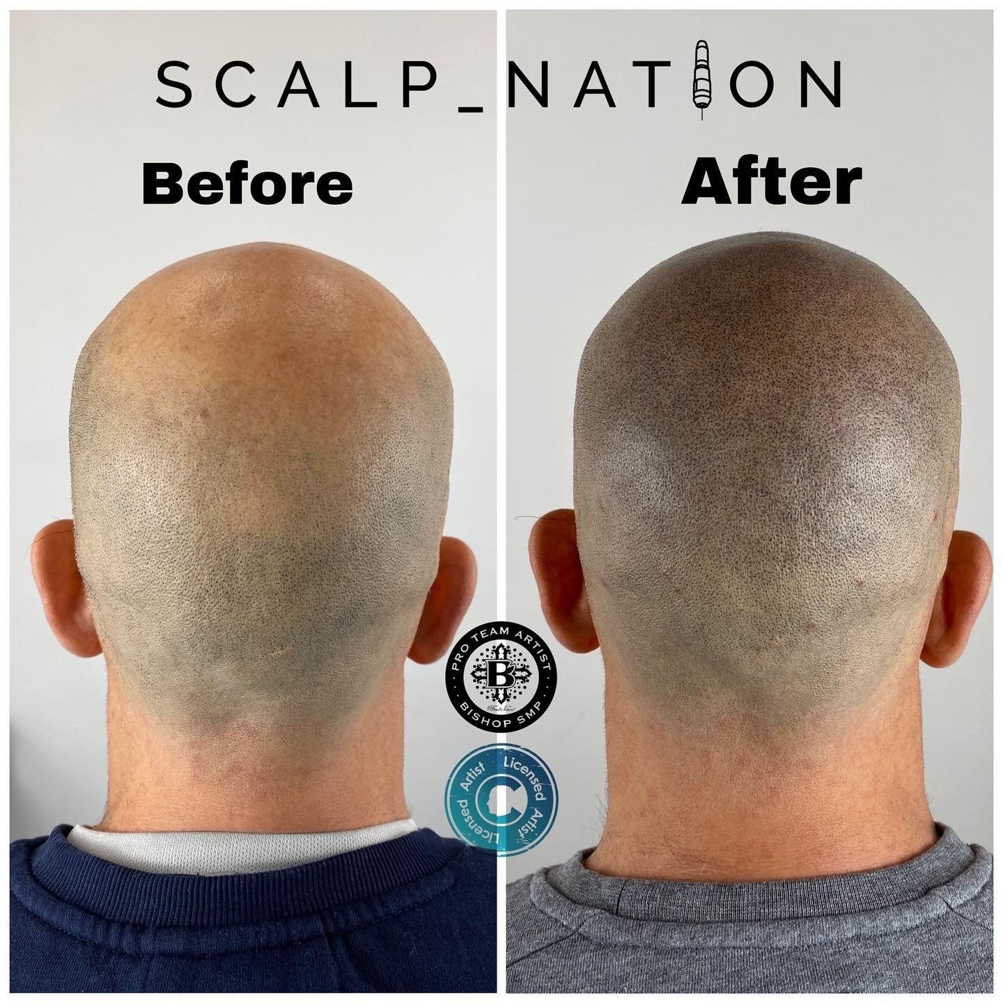 scalp micropigmentation