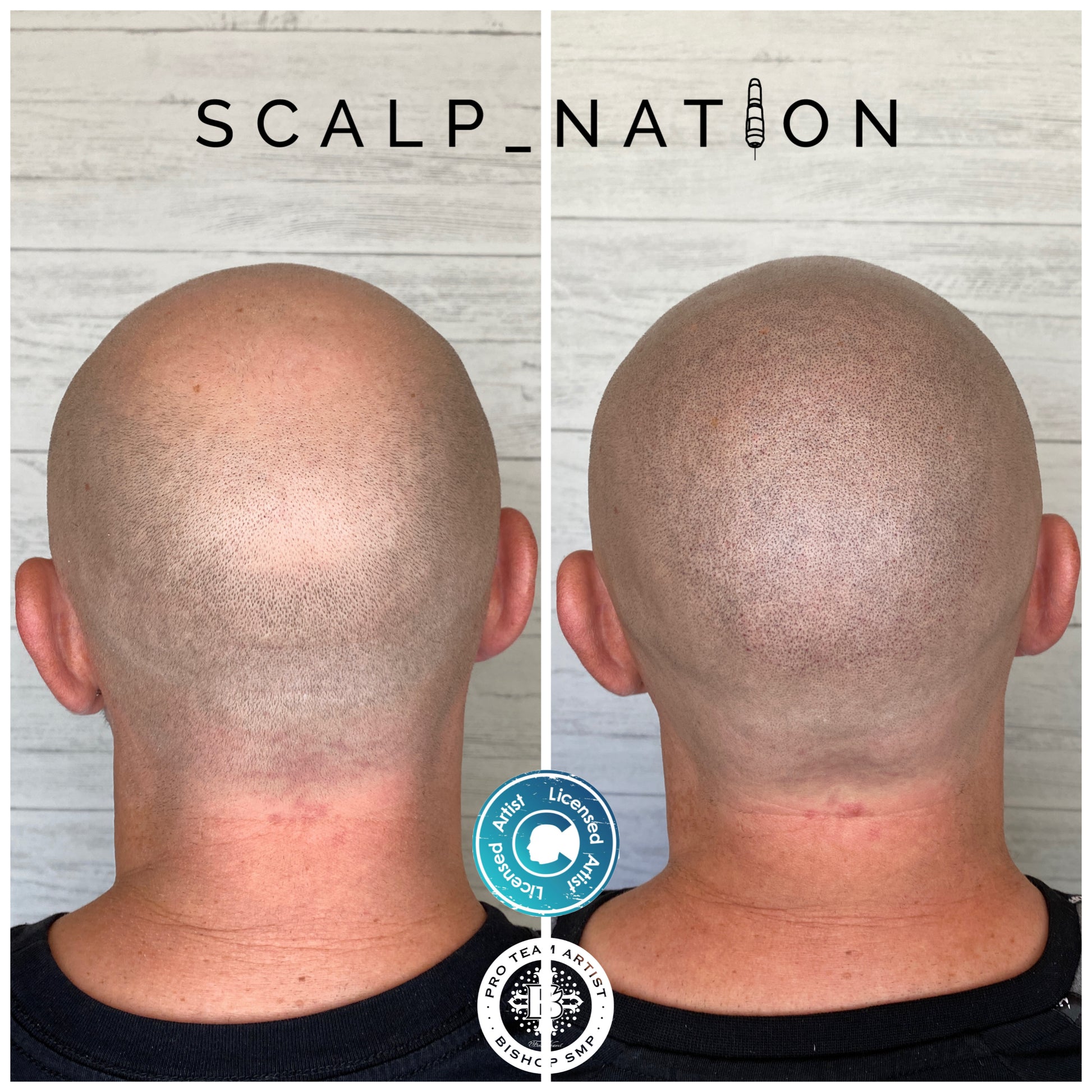 scalp micropigmentation