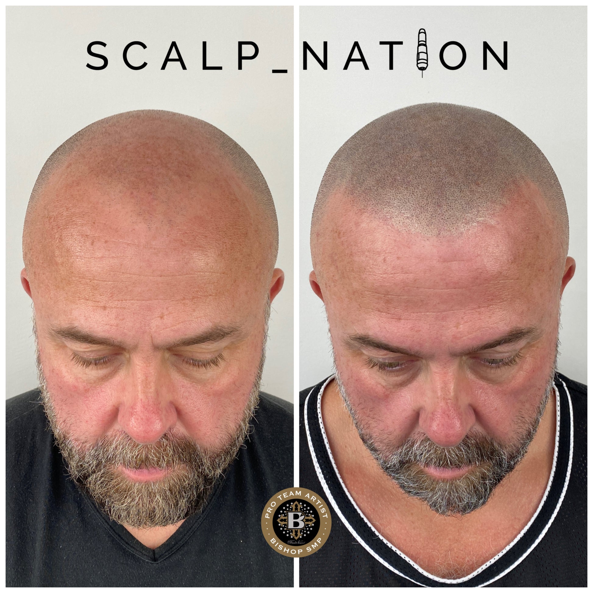 Scalp Micropigmentation Men