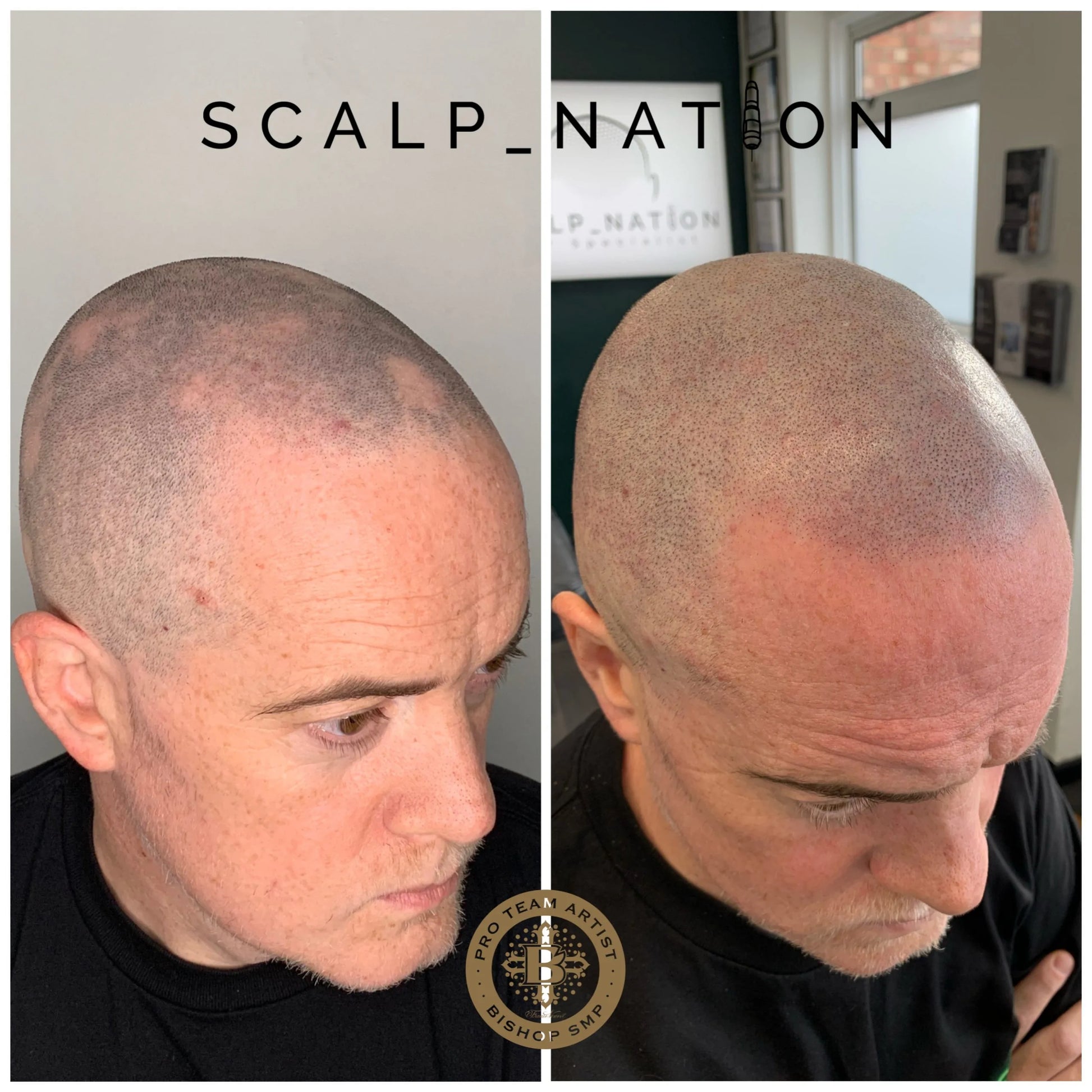 scalp micropigmentation halifax