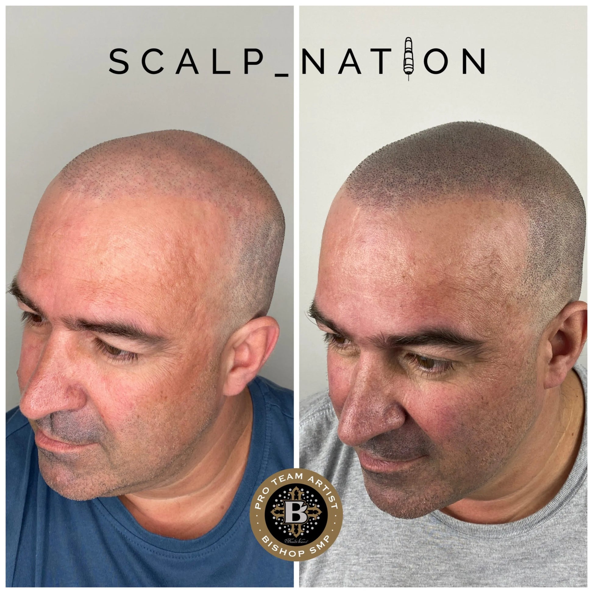 scalp micropigmentation halifax