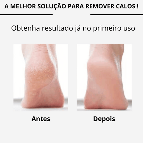 Lixa Elétrica Removedora de Calos + Kit Pedicure Profissional 8 Peças