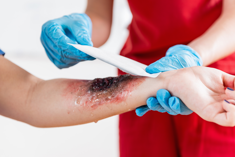 nurse placing bandage on burnt arm