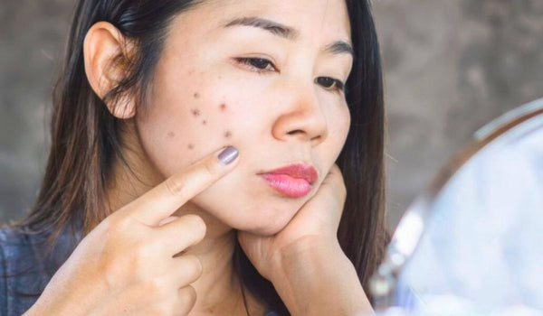 Does propolis fade dark spots?