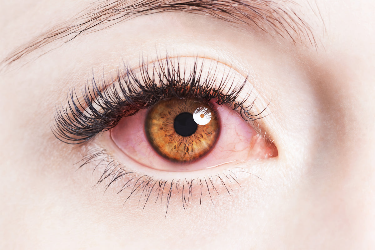 red-eye-here-s-what-causes-it-how-to-spot-it-and-what-you-can-do-abo