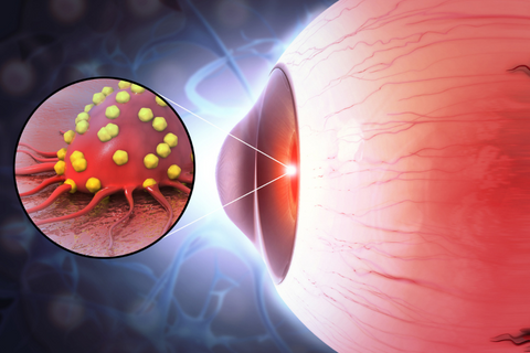 Eye cancer: Types, symptoms and the Treatments