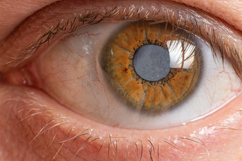Cataracts: Types, Symptoms, Risk Factors and the Treatment-I-Dew Eye drops