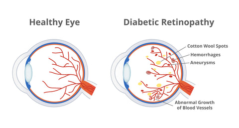 Diabetic Retinopathy:I-DEW Eye Drops