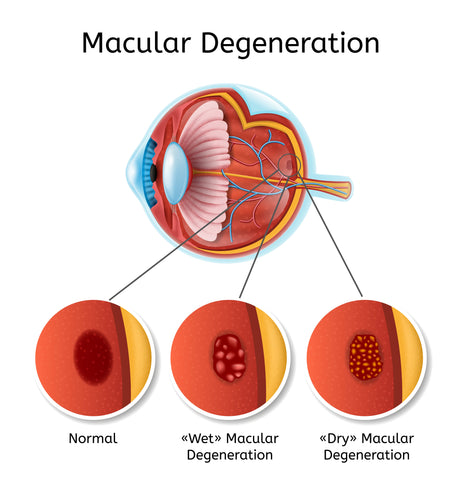 Age related Macular Degeneration: I-DEW Eye drops