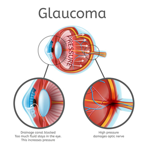 The truth about Glaucoma: I-Dew Eye drops