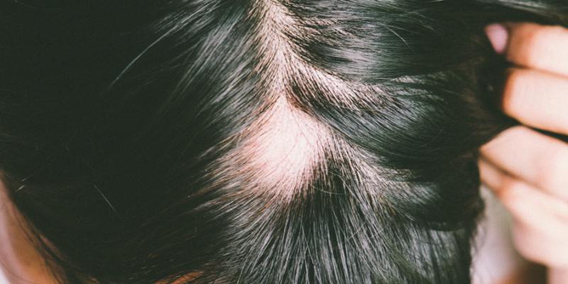 lichen planopilaris hair loss type