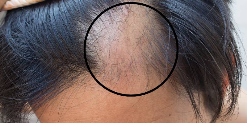 hair loss from medical condition