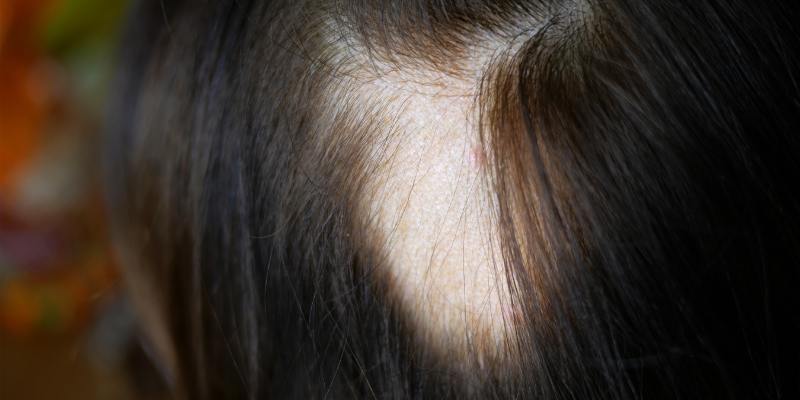 hair loss in woman