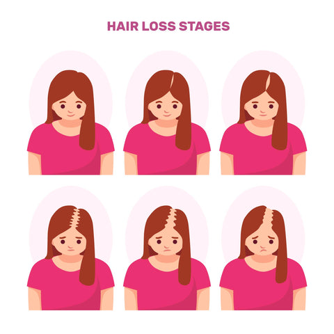 Hair loss stages women