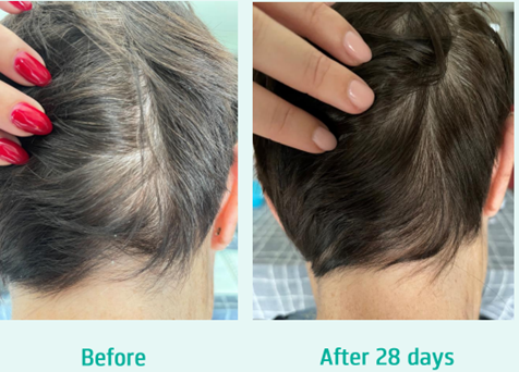 Before and after Neofollics scalp therapy