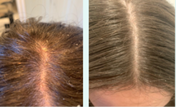 Before and after scalp line