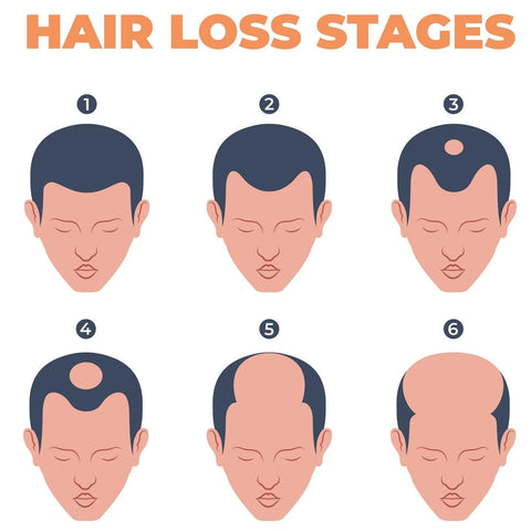 The 6 stages of hair loss - Norwood scale