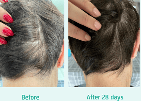 Neofollics before and after Scalp shampoo