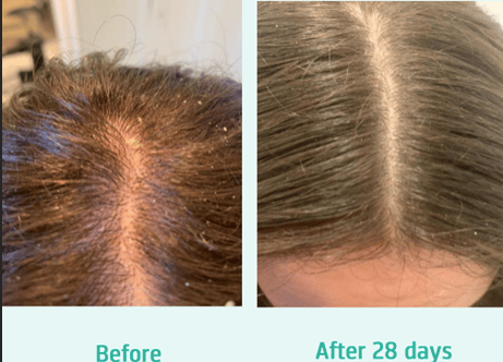 Before and after Neofollics Scalp shampoo