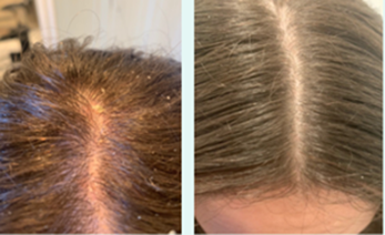 Before and after neofollics scalp therapy line