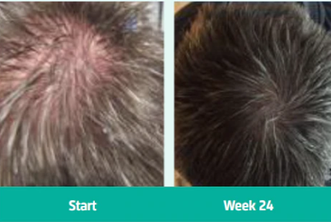 Before and after Androgenetic alopecia