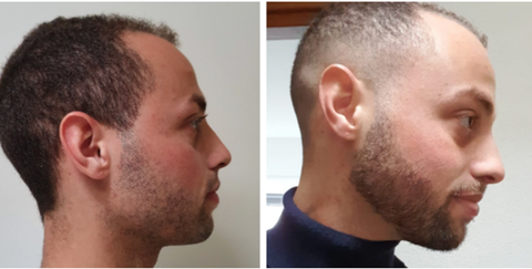 Man before and after Neofollics beard growth treatment