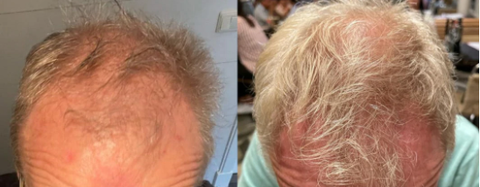 Hair Growth Supporting Tablets results