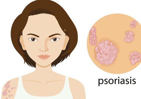 Psoriasis