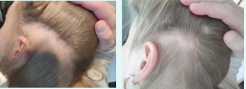 Results of a woman 67, experiencing seborrheic eczema and an sensitive scalp after using 'Neofollics Scalp Therapy Line products'