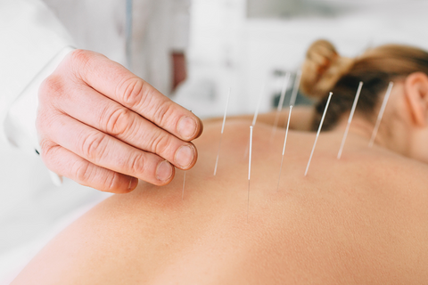 acupuncture