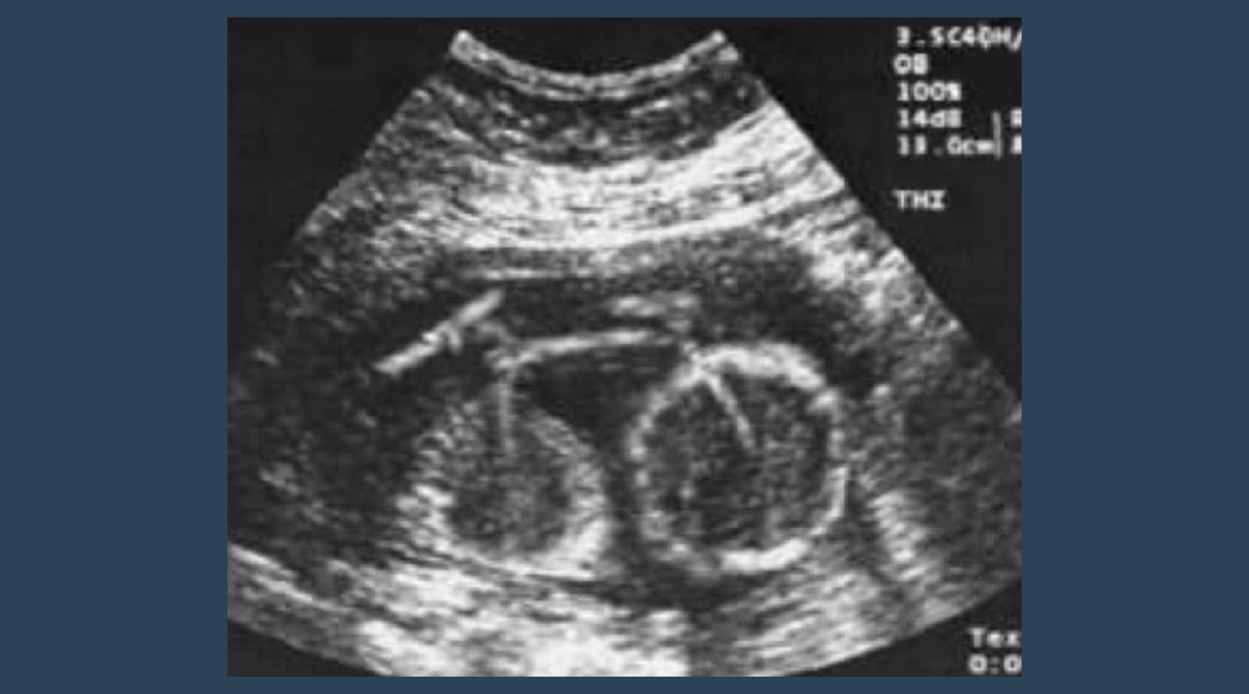 funny baby scan that looks like the baby is a bicycle