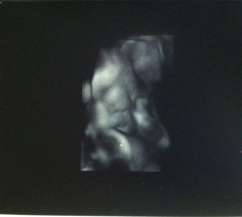 3D ultrasound image