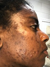 acne on black skin