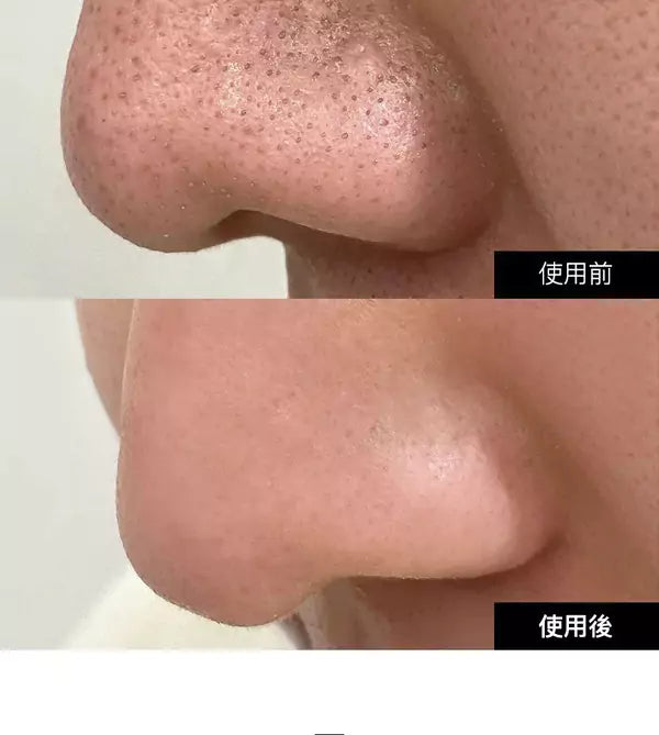 黑頭毛孔護理機 Beauty Suction