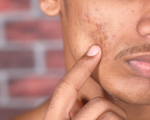 comment traiter l acne pour les homme a peau noire