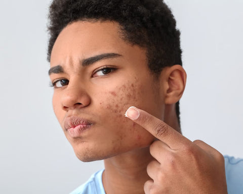 traiter l acne post inflammatoire sur les hommes a peau noire