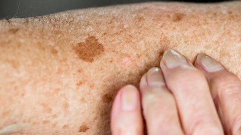 age spots on a mans arm