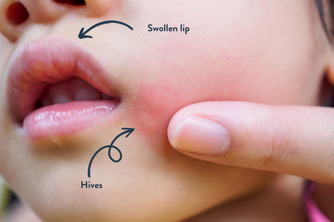Baby's face showing allergy symptoms including lip swelling and hives
