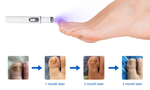 ARRIVALS Antifungal Laser Device Without Any Side Effects