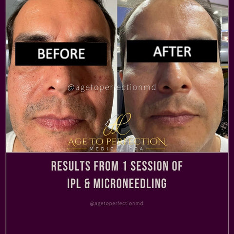 Microneedling