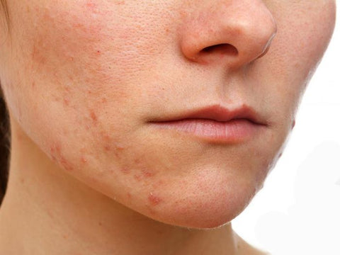 How to prevent or treat perioral dermatitis