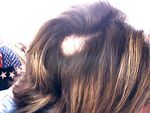 Compulsive hair pulling is a hidden epidemic that blights many peoples  lives
