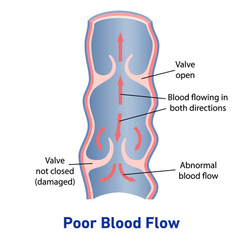 Poor blood flow diagram