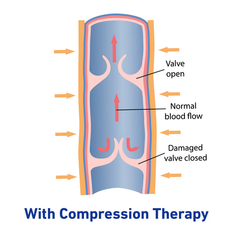 Diagram showing how compression therapy improves blood flow