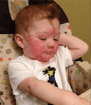 child with allergic reaction