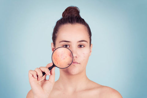 woman holding magnfying glass up to face to show acne