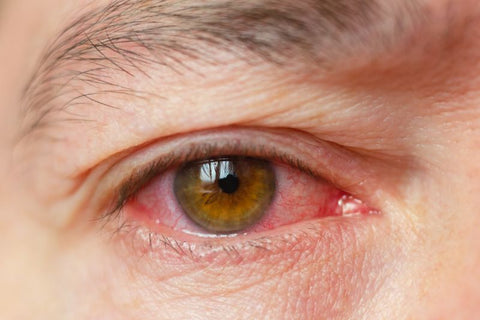 a close up of an irritated eye
