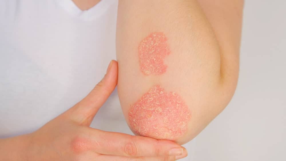 Huile de nigelle et psoriasis