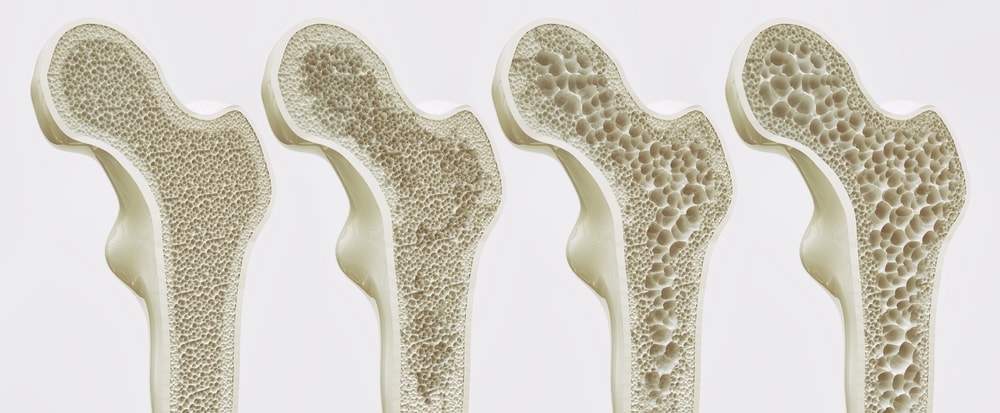 traitement naturel calcifications